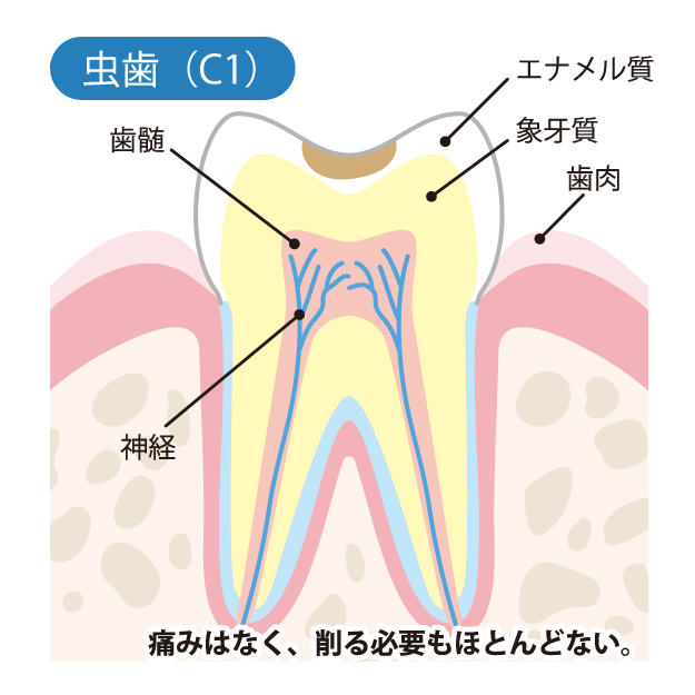 船橋市（芝山・飯山満）の歯医者、たお歯科クリニックでむし歯治療